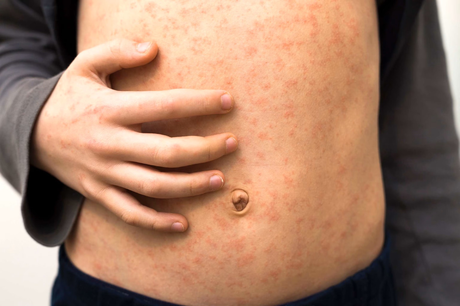 measles-rash-gty-jt-221122_1669155112087_hpEmbed_3x2.jpg